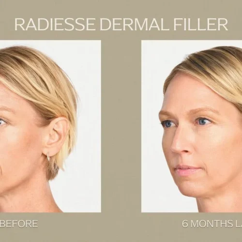 Radiesse